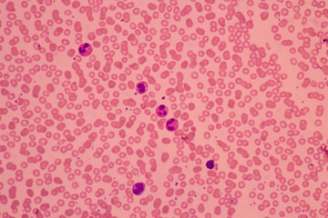 Human blood smear view in microscopy.Complete blood count for treatment. Polymorphonuclear...