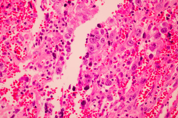 View in microscopic of pathology cross section tissue ductal cell carcinoma or adenocarcinoma diagnosis by pathologist in laboratory.H and E stain.Criteria of breast cancer.Medical concept