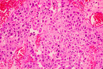 View in microscopic of pathology cross section tissue ductal cell carcinoma or adenocarcinoma...