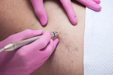 closeup of laser capillary removel procedure in medical clinic