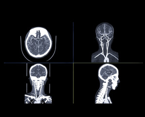  CTA brain or CT angiography of the brain  comparison Coronal and Sagittal view fusion 2D and 3D...