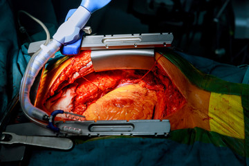 Heart ready for operation coronary artery bypass surgery