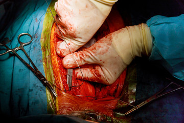 Surgeon hands the open heart procedure