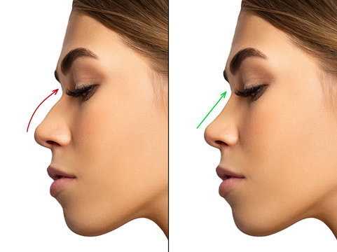 Nose Doubt: Review of “Nose Up” Bridge-Straightening Clip –  BeautyandtheCat's Beauty Blog