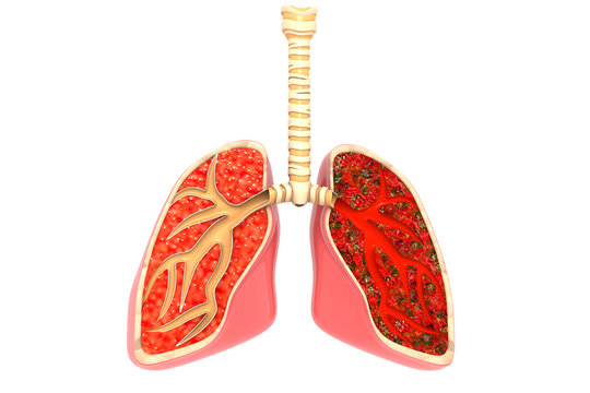 Lung Disease 3d render