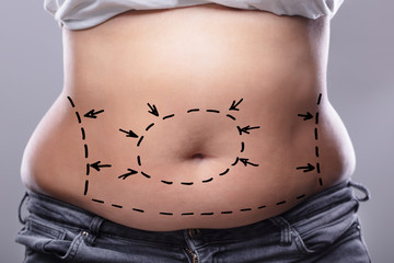 Woman's Belly With Drawing Arrows And Lines