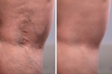 Treatment Of Varicose Before And After