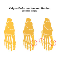 Age and valgus deformity of the thumb. Bunion. Stages of development of the disease. Silhouette of the foot bones. Vector illustration