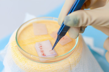 Hair follicles in the Cup close-up. Baldness treatment. Hair transplant. Surgeons in the operating room carry out hair transplant surgery. Surgical technique that moves hair follicles from a part of