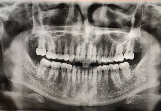 X ray film of human mouth with healthy teeth. Detail of panoramic facial x-ray image