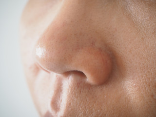blackhead and pimple on the nose in woman cause of oily skin and large pore using for skincare and cleansing or beauty product concept.
