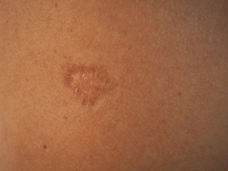 Fototapeta premium Contracture scar on arm skin women using for health care and beauty concept.