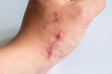 The scar on his arm near the wrist on a white background. Two scars next to each other on the arm, close-up. Not isolated.