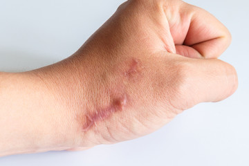 The scar on his arm near the wrist on a white background. Two scars next to each other on the arm,...