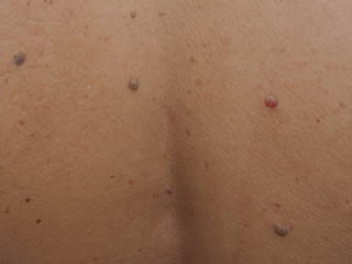 mole or melanoma black color on back women of skin lesion case of proliferation of pigment derma cells and melanocytic pigmented naevus using for health care concept.