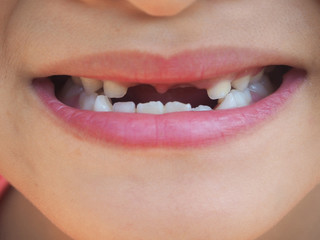 Incisor broken upper teeth and diastemas in the little child girl using for dental concept.