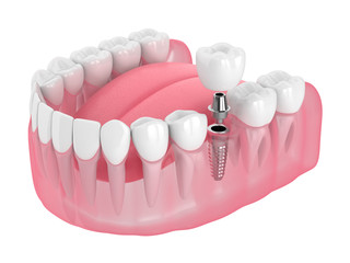 3d render of jaw with dental implant - obrazy, fototapety, plakaty
