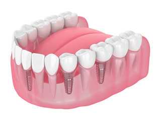 3d render of jaw with dental implants