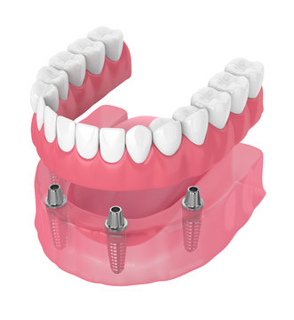 3d Render Of Removable Full Implant Denture
