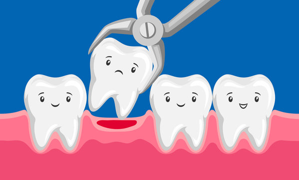 Illustration tooth is removed by forceps in oral cavity.