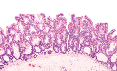 Microscopic image (photomicrograph) of a sessile serrated adenoma of colon.  Similar to tubular and...