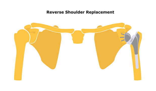 Reversible Shoulder Replacement. Shoulder joint replacement, endoprosthetics. Osteoarthrosis of the shoulder joint. Vector illustration. Flat design.