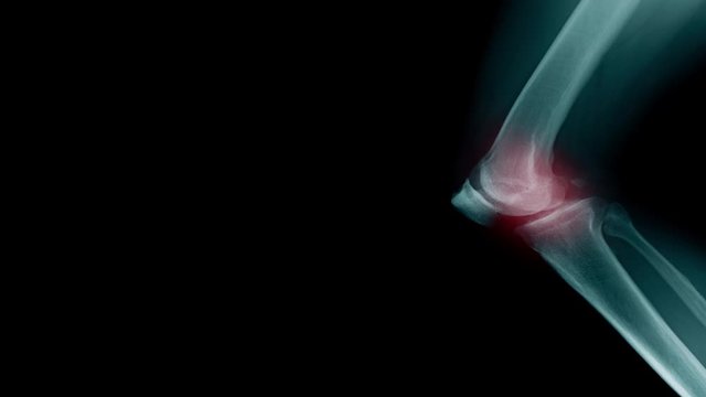 OA knee x-ray, hight quality footage OA knee x-ray in blue tone 
