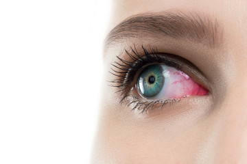 Eye inflammation. Female open red sight with contact lens , close up.