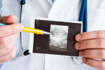 Intussusception of intestine in hepatic flexure of colon on ultrasound image concept photo. Doctor indicating by pen on printed picture ultrasound pathology. Photo for diagnosis, radiology, surgery