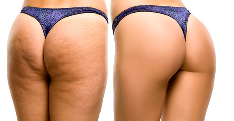 Female buttocks before and after on white background - obrazy, fototapety, plakaty