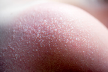 Skin care concept. Handsome guy got sunburn and got tan lines on his shoulder. The skin sloughs off...