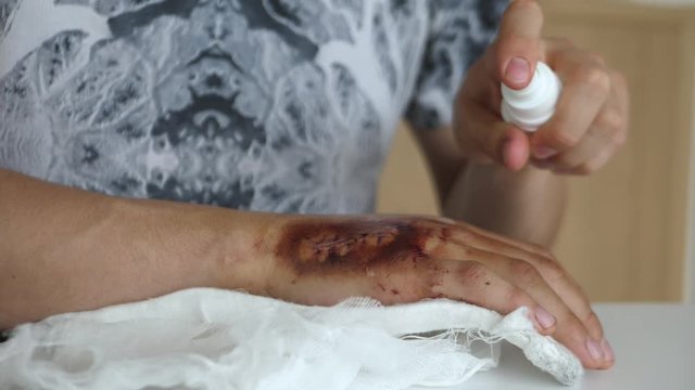using antiseptic on a wound