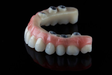 dental prosthesis of the upper jaw is shown fixation on implant abutments on the other hand © Dental Pro Content