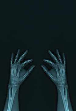 X-Ray Of The Hands