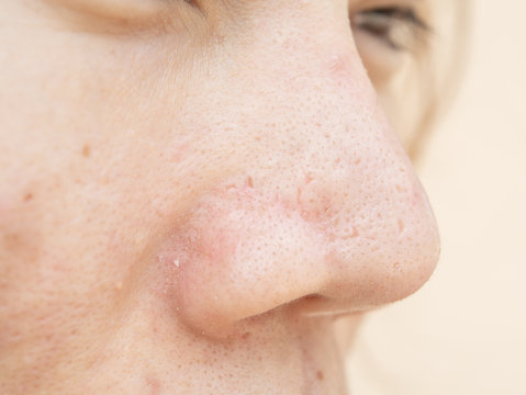 Acne scars and pores. In the nose Black spots, wrinkles and skin problems