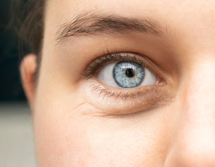 A closeup view on the open eye of a beautiful young Caucasian woman, showing a blue iris, with a swollen eye bag beneath caused by fluid retention.
