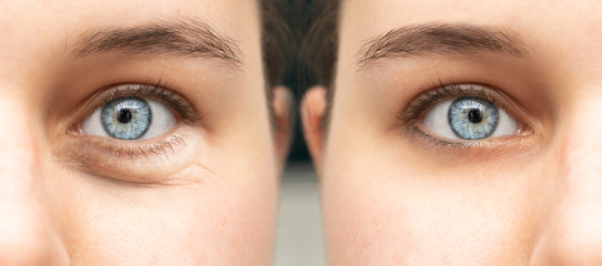 A closeup view on the blue eyes of a young pretty lady, split screen is used to show the results of...