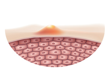 The concept of skin that is acne or inflammation on human skin Is a medical symbol for the treatment of skin diseases By using drugs or lasers to treat. Vector Realistic file.