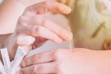 Hand applying acupuncture needle