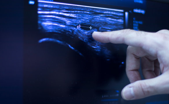 EPI dry needling ultrasound scan