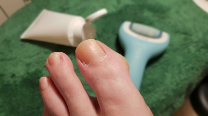 Treatment of a callus of a toe