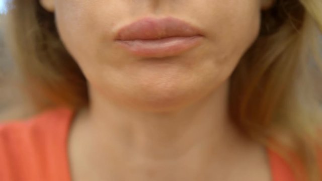 to close. woman with herpes on her lip eats french fries and hamburger