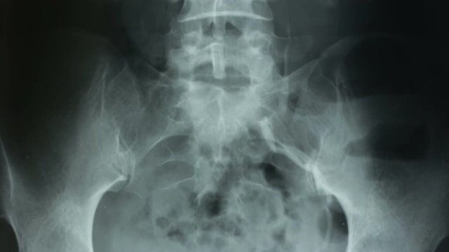 Vertical tracking, of a urography with a contrast method of the kidneys and the human bladder.