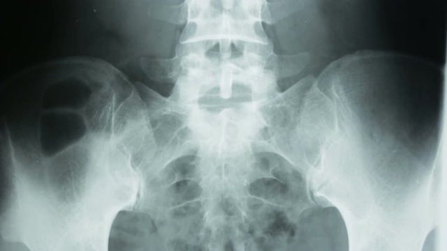 Vertical tracking, of a radiograph details of pelvic bones and human spine.