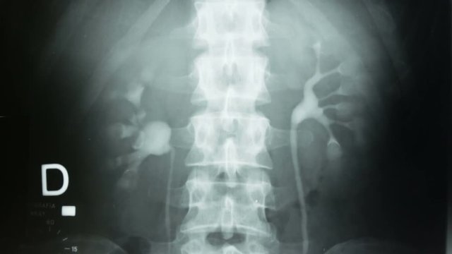 Vertical tracking, of a urography with a contrast method of the kidneys and the human bladder.