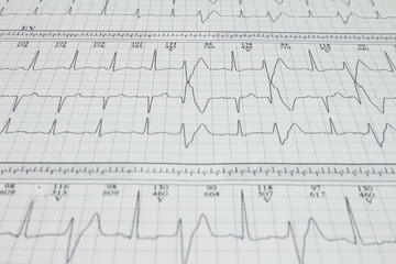 Ventricular extrasystole Bigeminism Cardiac arrhythmia recorded on an electrocardiogram.