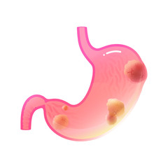 Vector isolated illustration of stomach cancer 