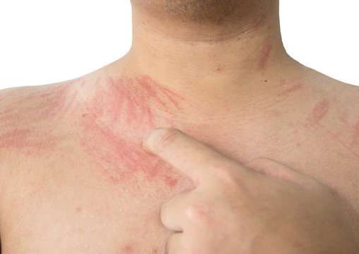 Allergy dermographism or dermatographia on skin. 