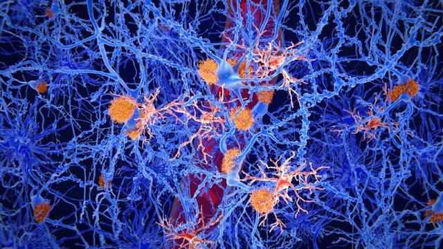 Microglia cells (red) play an important role in the pathogenesis of  Alzheimer's disease. Neurons (light blue), amyloid plaques (orange).