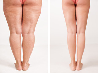 Comparison before and after weight loss. Women's legs. The result of liposuction. The fight against...